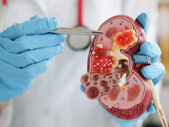 Kidney Stone Myths vs. Facts: What You Need to Know