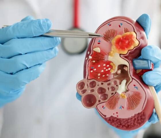 Kidney Stone Myths vs. Facts: What You Need to Know