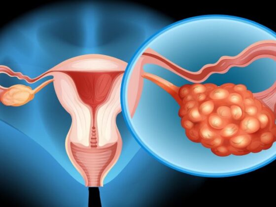 Ovarian Cancer: All You Need to Know – Complete Guide