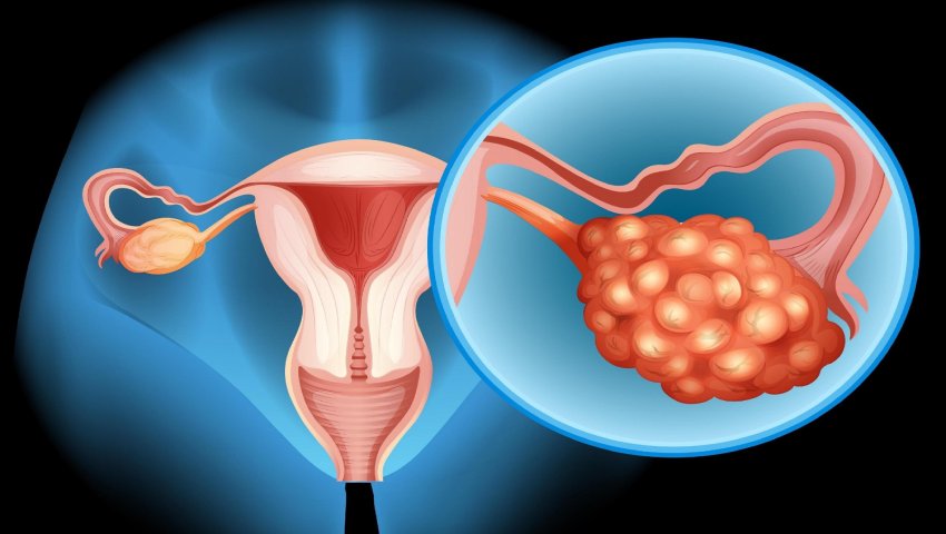 Ovarian Cancer Treatment at Apex Superspeciality Hospital in PCMC, Pune