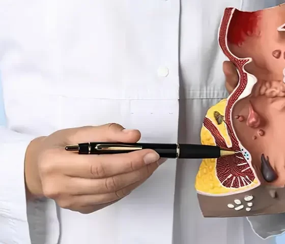 How to Choose Your Piles Doctor