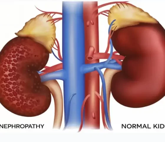 Early Warning Signs of Kidney Damage in Diabetes Patients You Shouldn’t Ignore